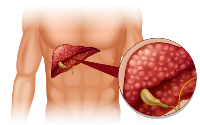 Can Fatty Liver Disease Be Reversed? Everything You Should Know