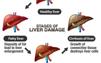 10 Signs of Liver Damage You Shouldn’t Ignore